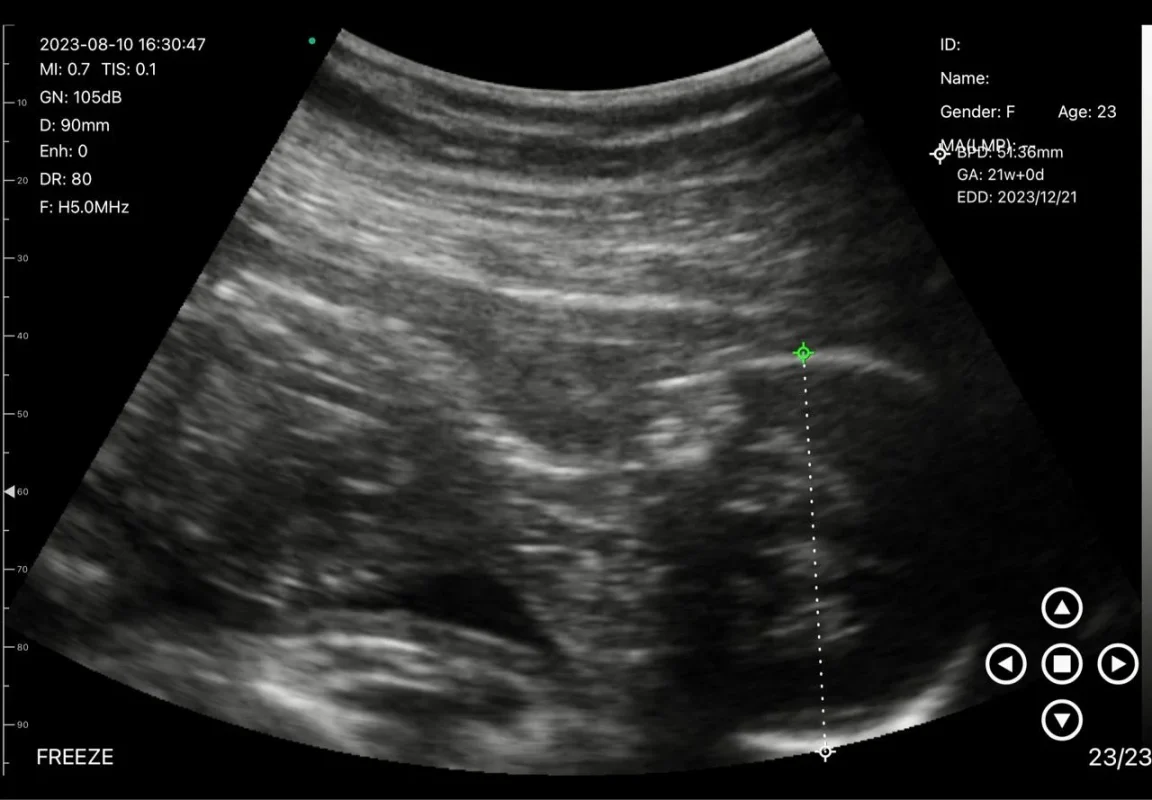 echobeeld van foetus van 21 weken door suresult pocket ultrasound