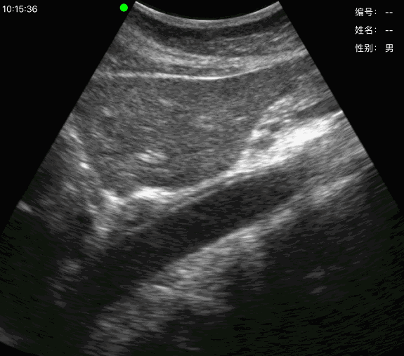 abdominale aorta