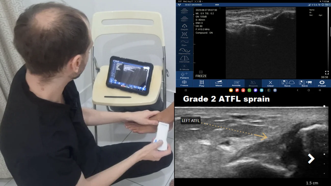 posicionamiento de la sonda de ultrasonidos atfl en el tobillo lateral y exploración del esguince de grado 2 resultante mediante suresult d3ultra