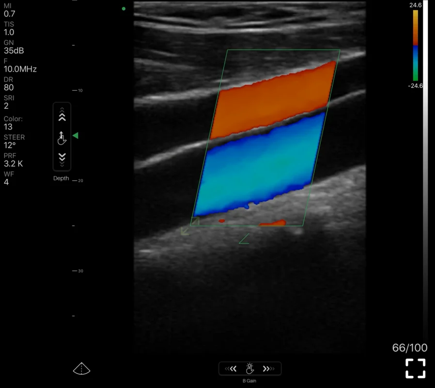 kleurendoppler-echografiebeeld van de carotis door suresult handheld echografie