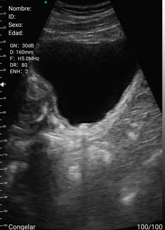 dolphin medical draadloze echoscanner klinische galerij urologie blaas