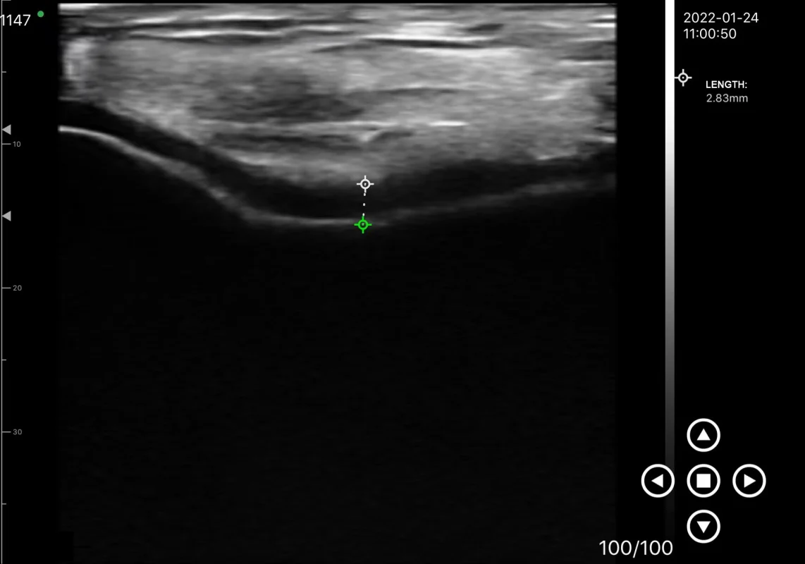 knie-echobeeld van suresult d3ultra