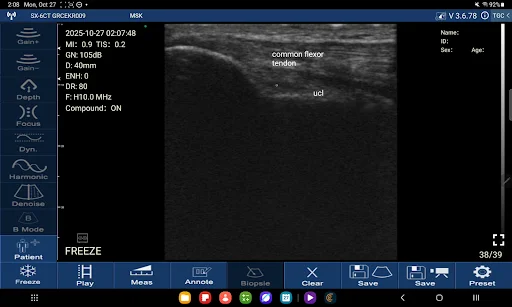 echografie van de mediale elleboog met de gemeenschappelijke flexorpees en het ucl in de lengteas, gemaakt met suresult d3ultra