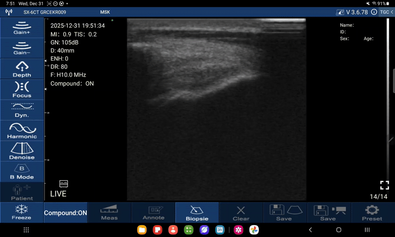 supraspinatus bij dynamische abductie en de pees in de lengteas