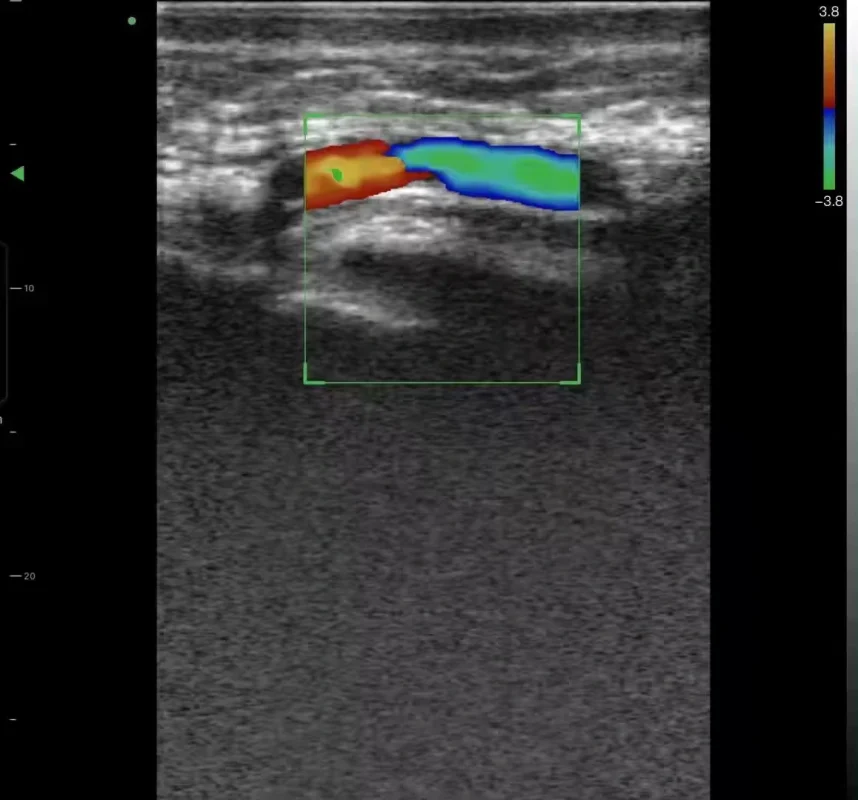 suresult hoogfrequente lineaire probe l20 kleurendopplerbeeld voor esthetische geneeskunde