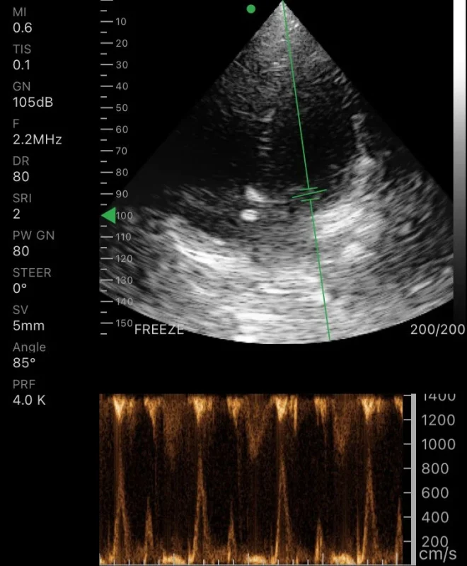pd1 draagbare handheld phased array-echoprobe voor cardiologie