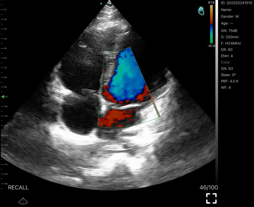 suresult draadloze draagbare echoscanner sectorprobe (phased array) c-mode cardiale kleurendoppler