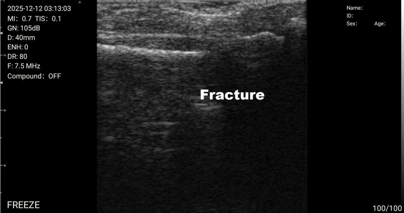 ecografía fractura del dedo del pie alteración cortical patología