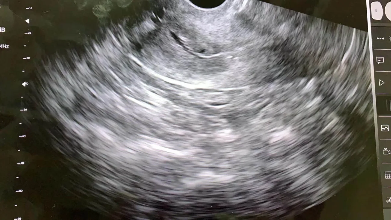 echobeeld van baarmoederlichaam, cervix en endometrium met suresult handheld echografie transvaginale probe