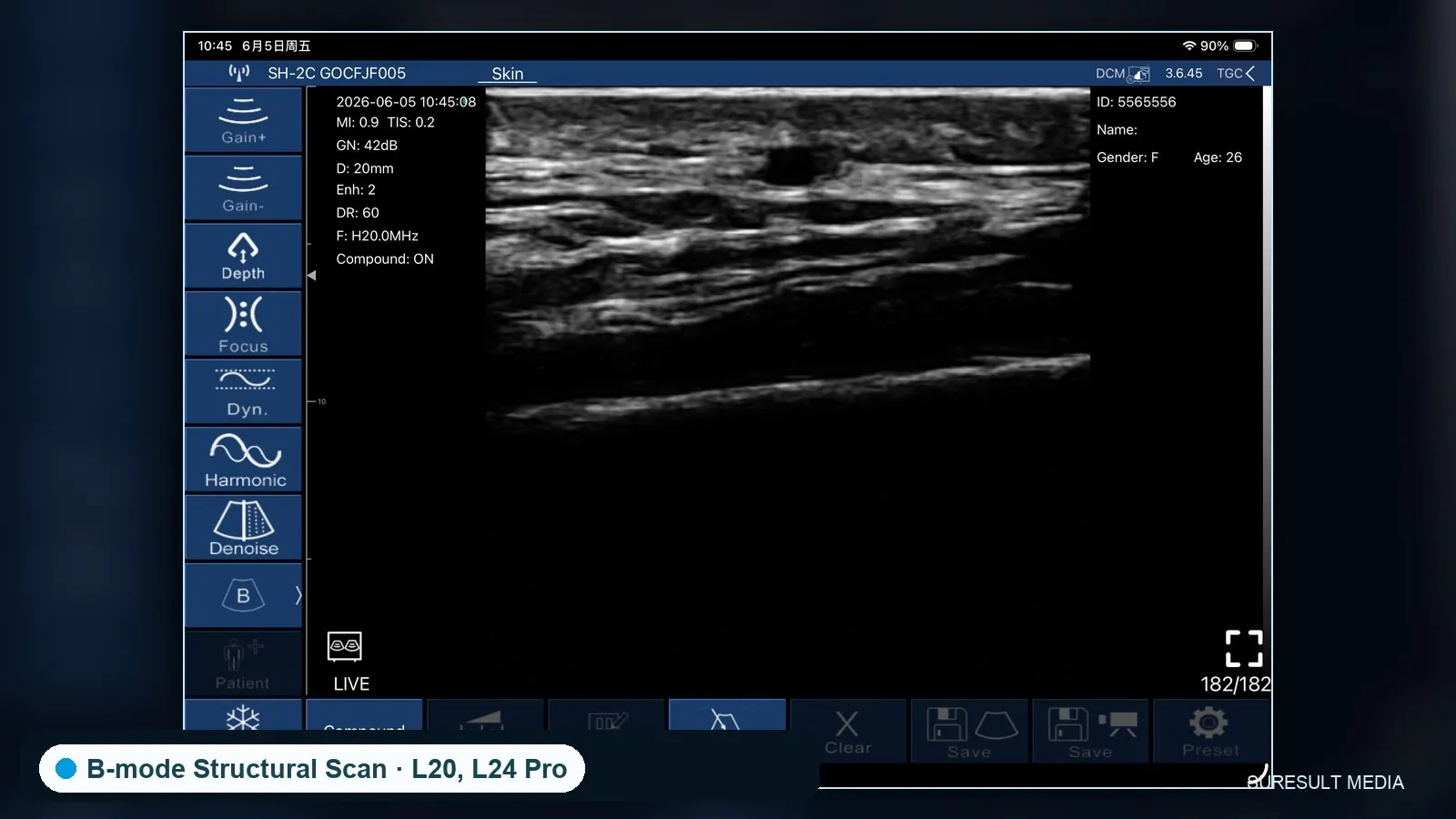 Forehead superficial tissue · B-mode · 20 MHz scan preview