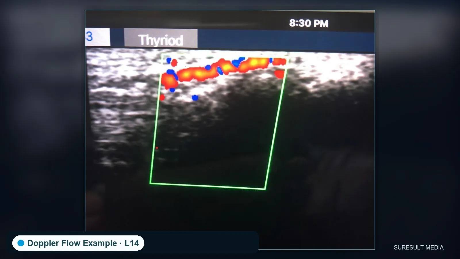 Finger artery · Color Doppler · L14 · Linear probe scan preview