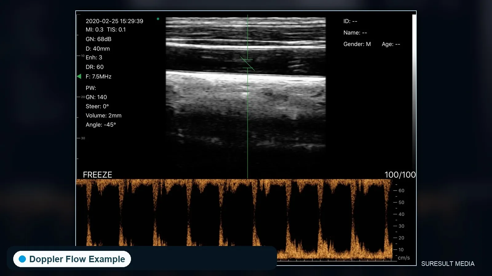 Carotid artery and internal jugular vein · PW Doppler · L10 · 10 MHz scan preview
