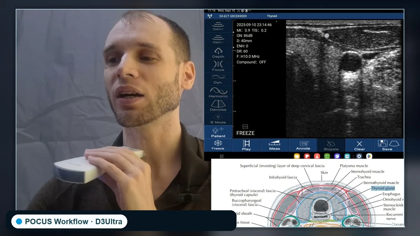 D3Ultra Thyroid Nodule POCUS Scan scan preview
