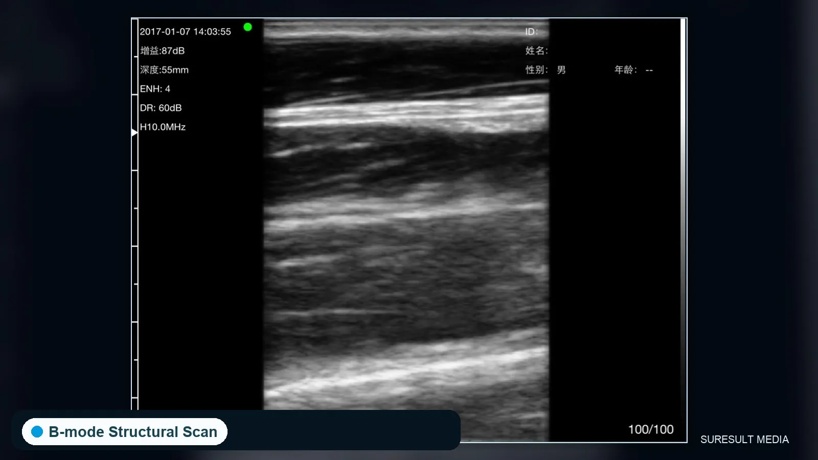 Finger flexor tendon · B-mode · D3 family · Linear probe scan preview