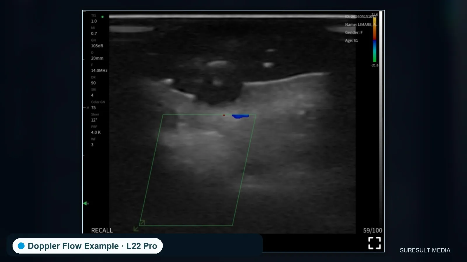 Facial superficial tissue · Color Doppler · L24Pro · Linear probe scan preview