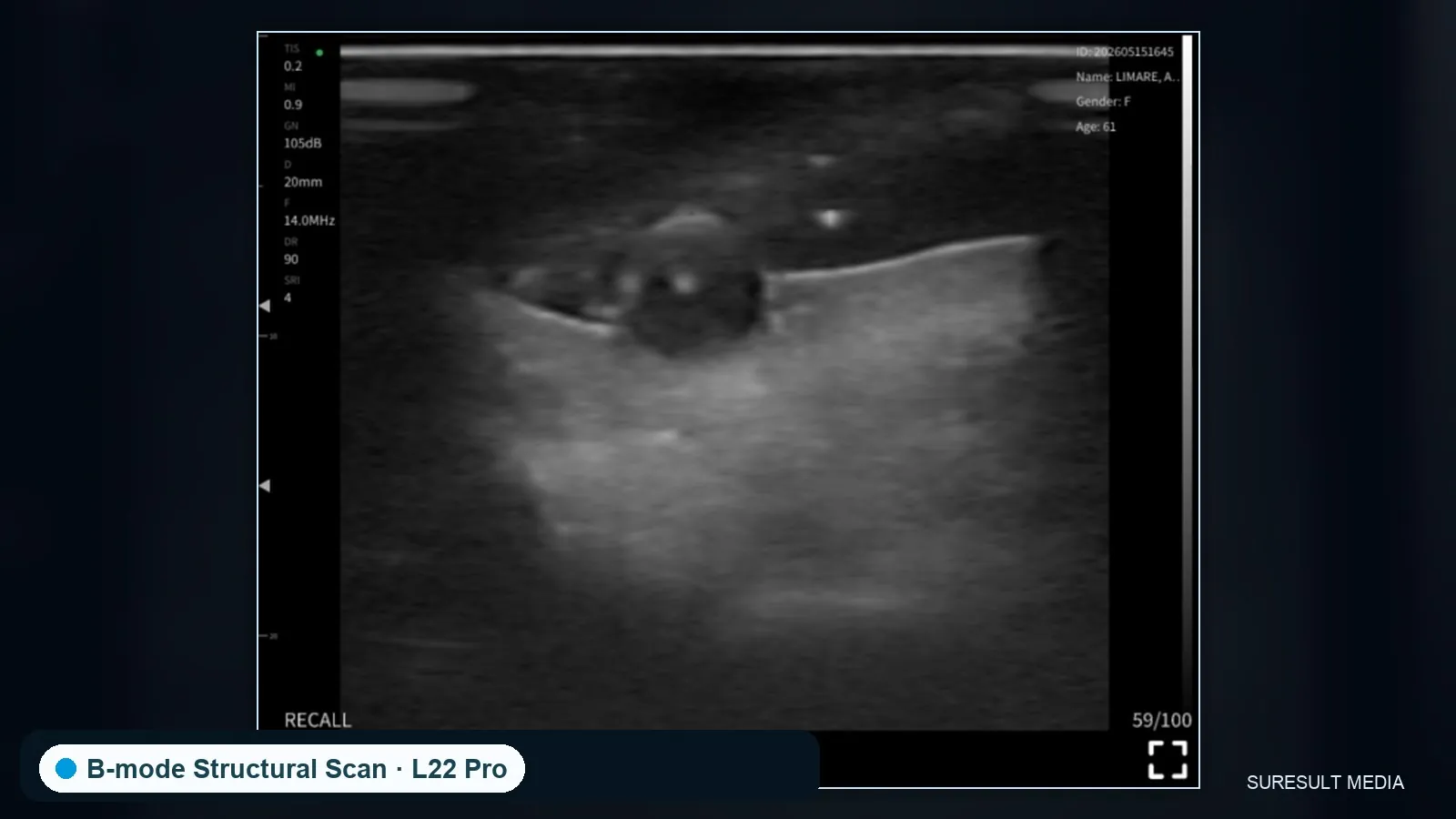 Facial superficial tissue · B-mode · L24Pro · Linear probe scan preview