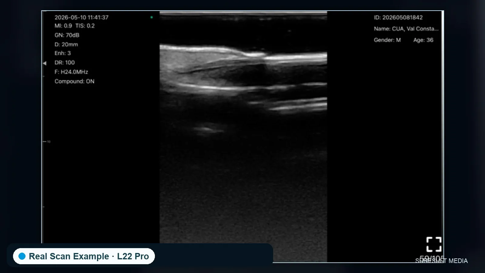 Nail unit, longitudinal · B-mode · L24Pro · 24 MHz scan preview