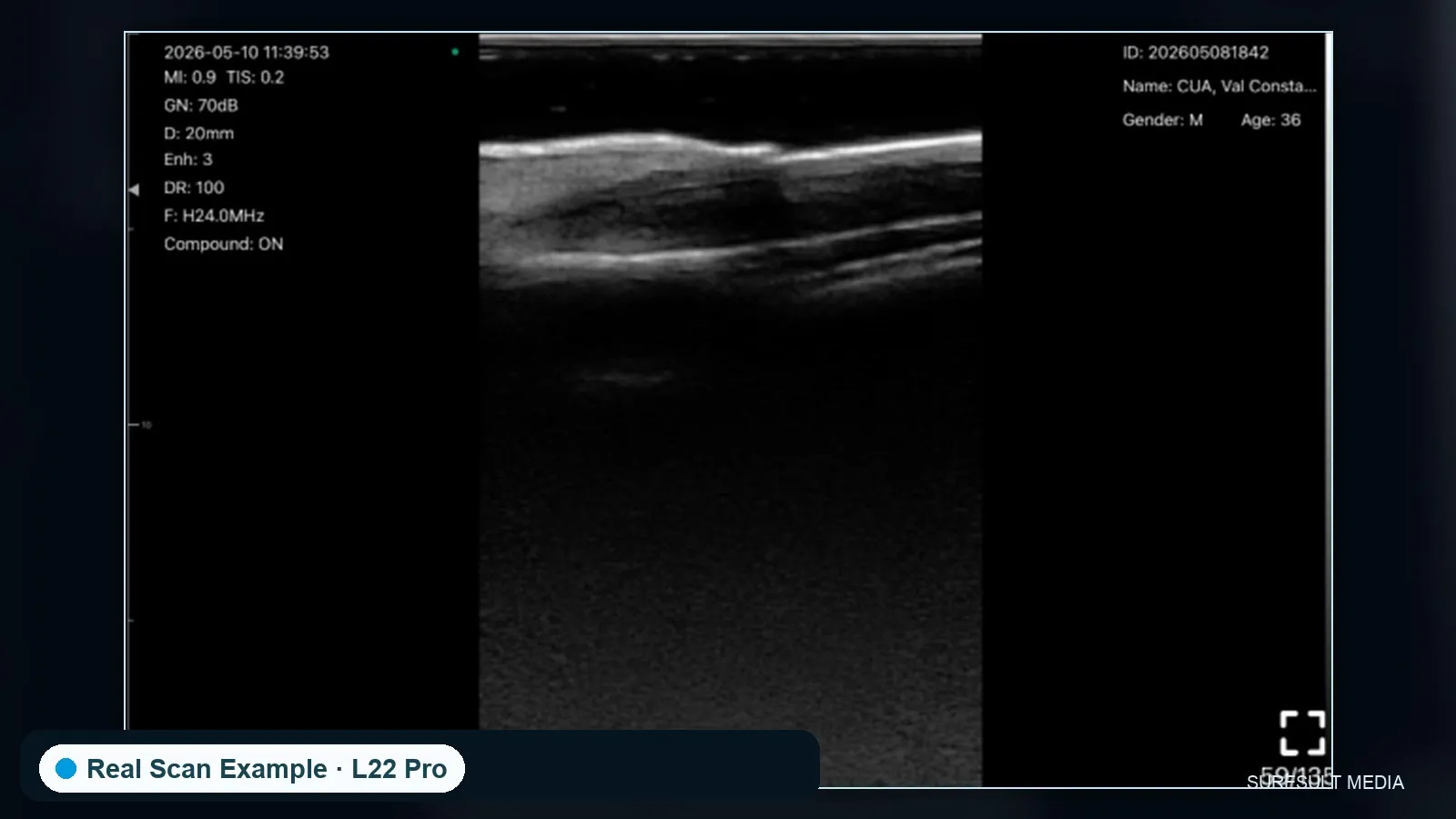 Nail unit, longitudinal · B-mode · L24Pro · Linear probe scan preview
