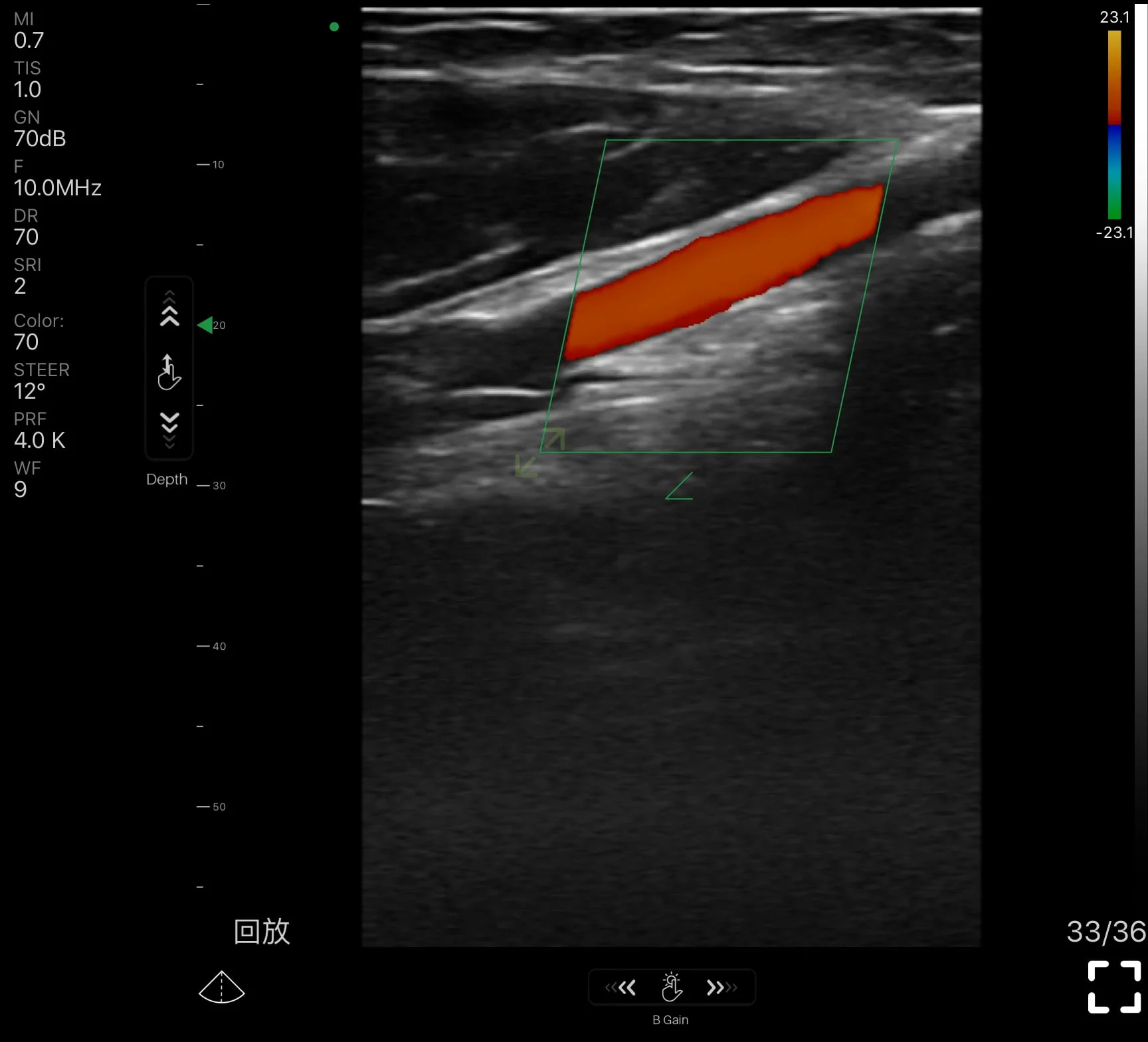 Bovenarmslagader, kleurendopplerscan van een Suresult handheld echografie