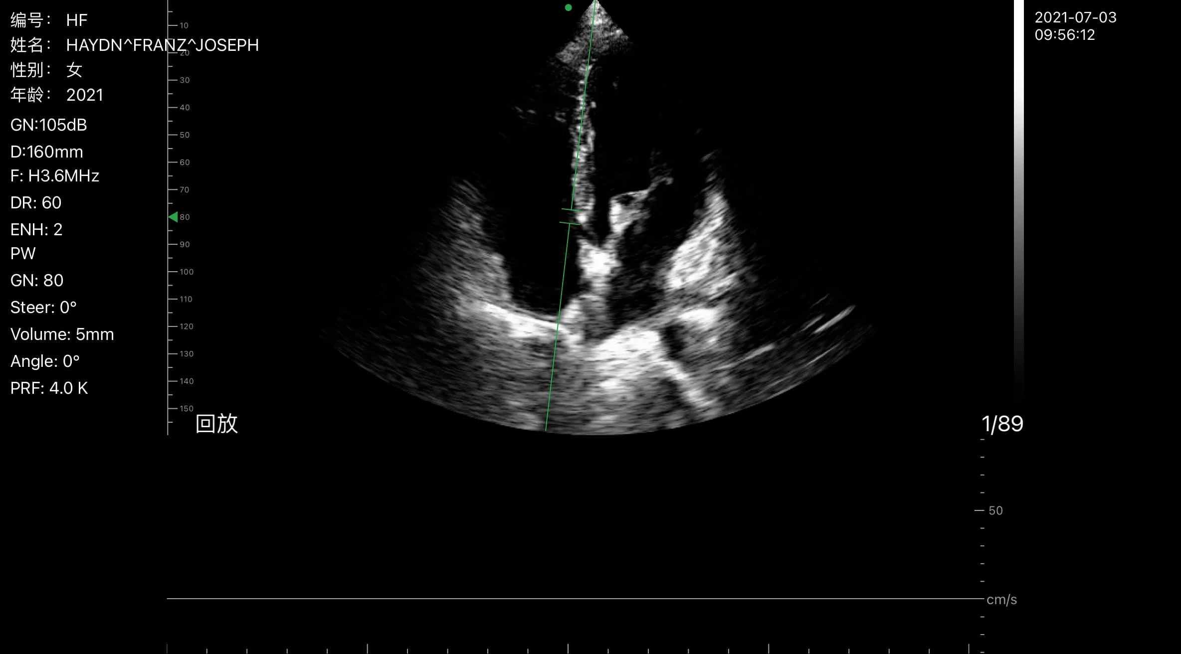 Cardiaal, PW-dopplerscan van een Suresult handheld echografie