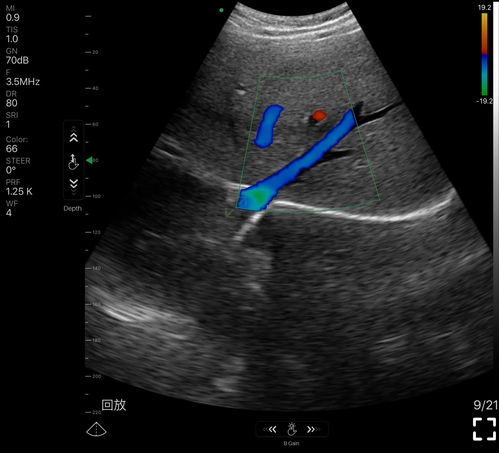 Lever, kleurendopplerscan met een Suresult handheld echografie