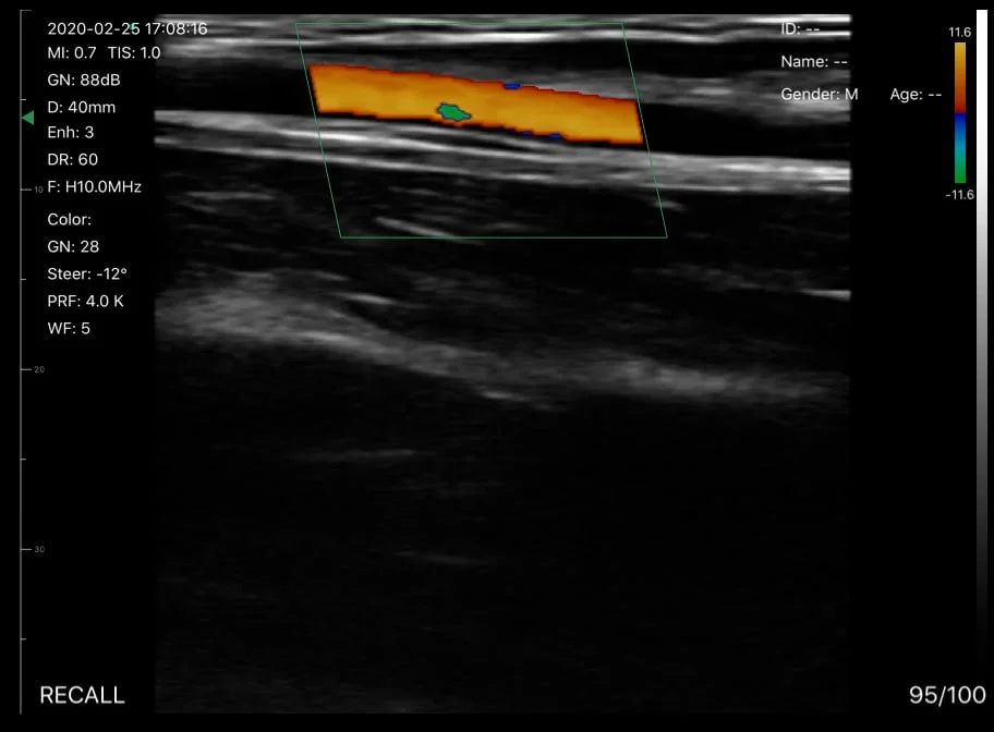 Scan van polsvaten van een Suresult handheld echografie