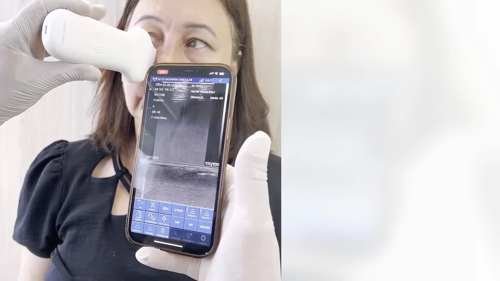 Aesthetic ultrasound workflow with handheld ultrasound and phone display