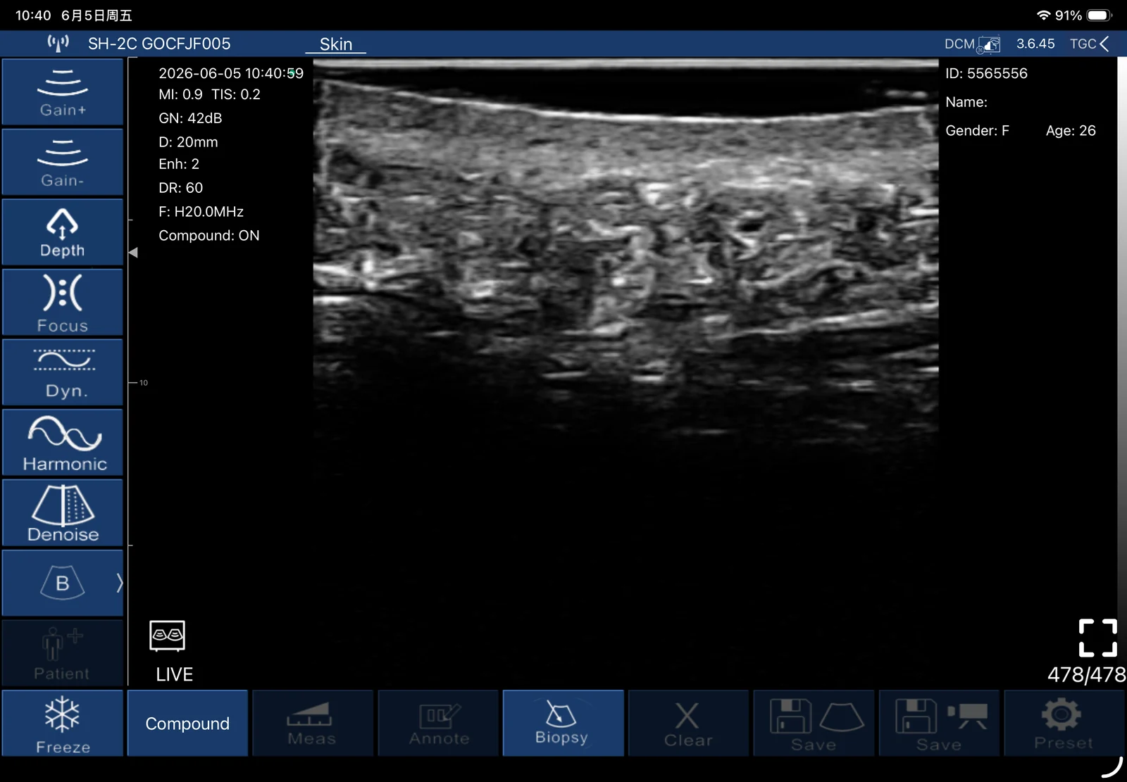 Epidermis, dermis and subcutaneous tissue at 20 MHz on a Suresult L20Pro, 20 mm depth