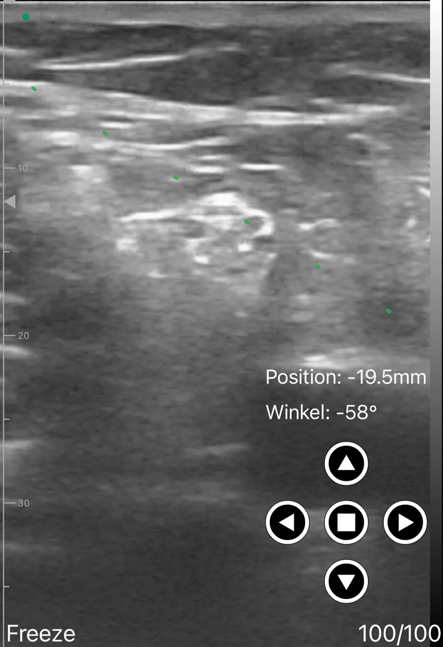 Distal sciatic block ultrasound view on Suresult D3Ultra