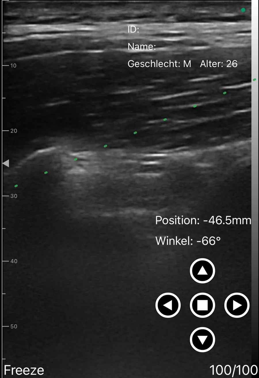Erector spinae plane block ultrasound view on Suresult D3Ultra