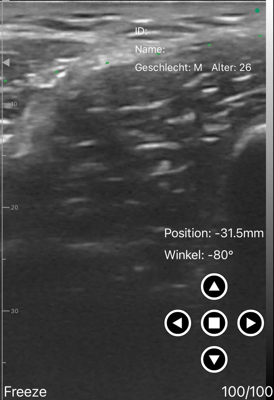 Suprainguinal fascia iliaca block ultrasound view on Suresult D3Ultra