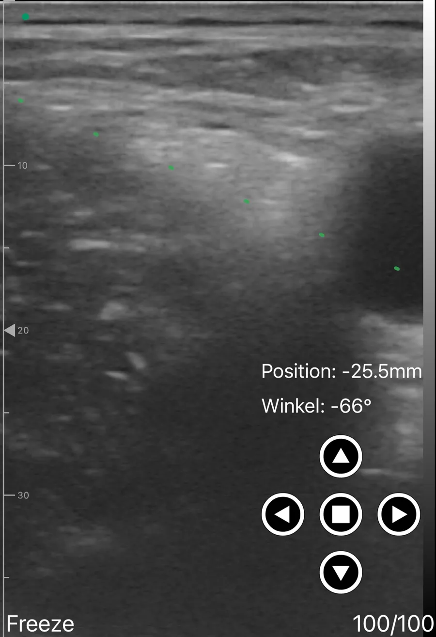 Femoral nerve block ultrasound view on Suresult D3Ultra