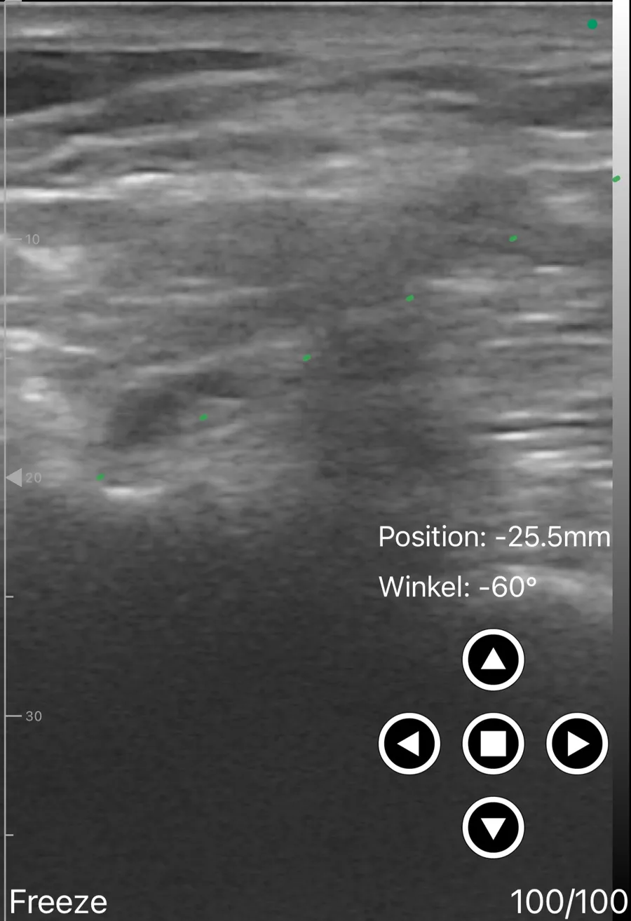 Interscalene brachial plexus block ultrasound view on Suresult D3Ultra