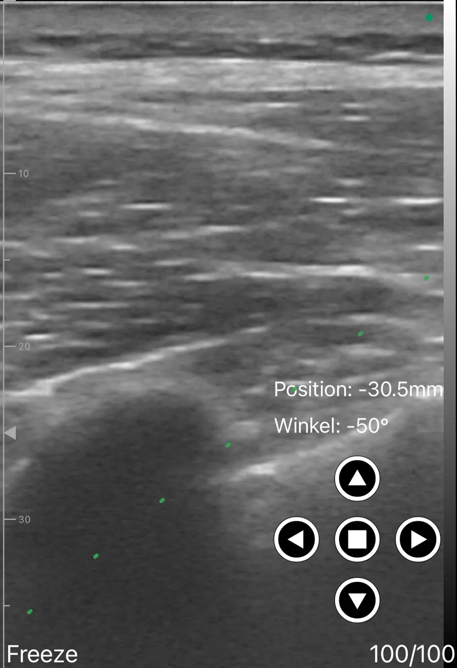 Paravertebral block ultrasound view on Suresult D3Ultra