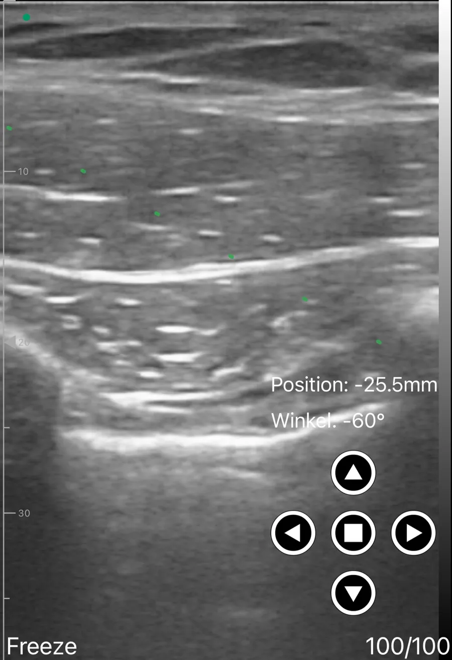 PECS block ultrasound view on Suresult D3Ultra