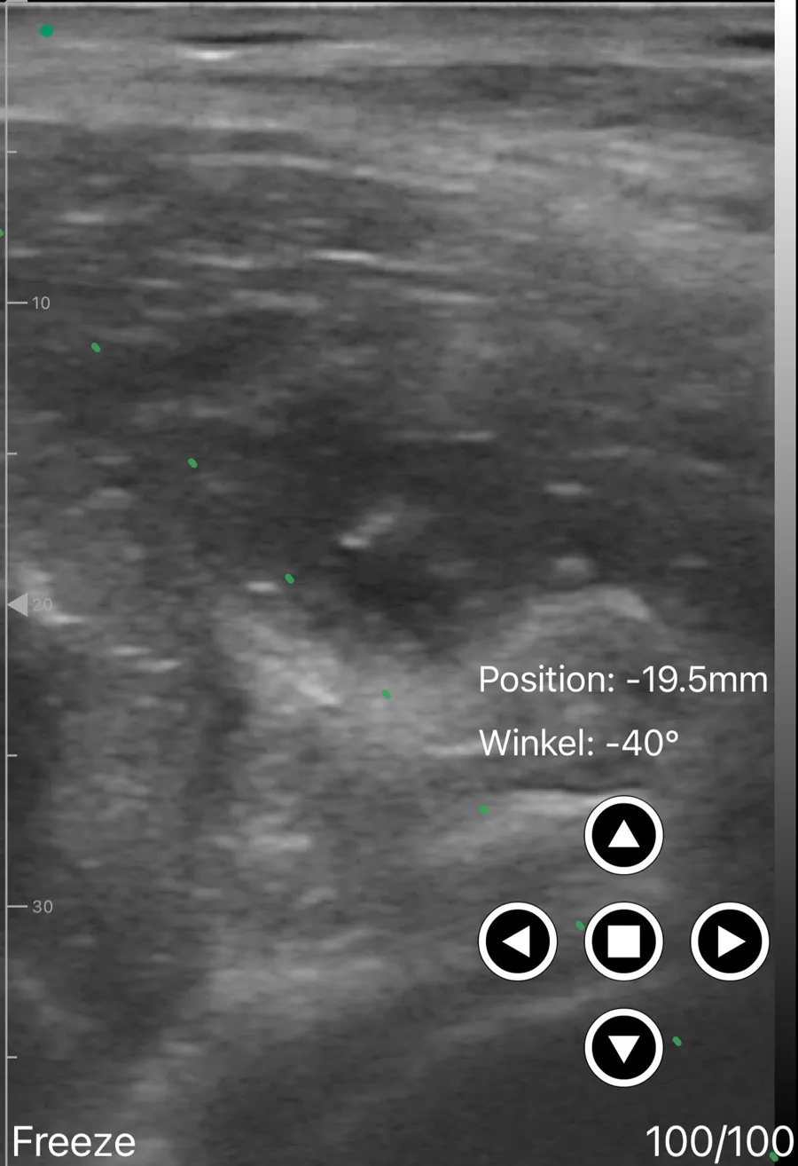 PENG block ultrasound view on Suresult D3Ultra
