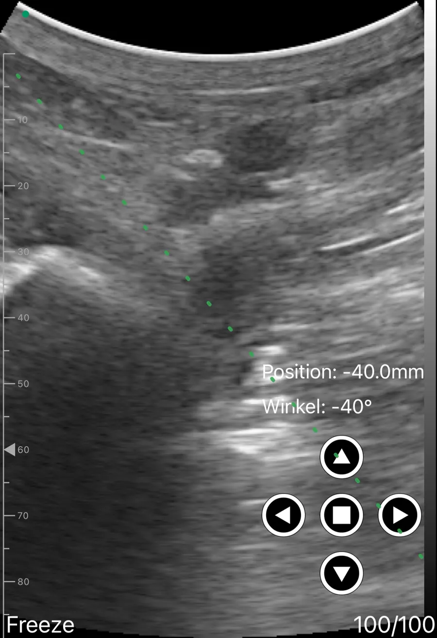 Proximal sciatic block (anterior) ultrasound view on Suresult D3Ultra