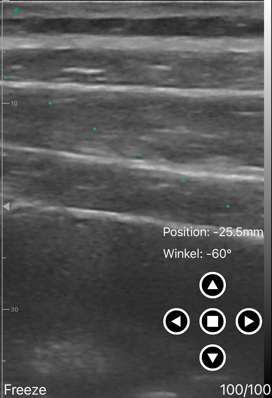 TAP block ultrasound view on Suresult D3Ultra