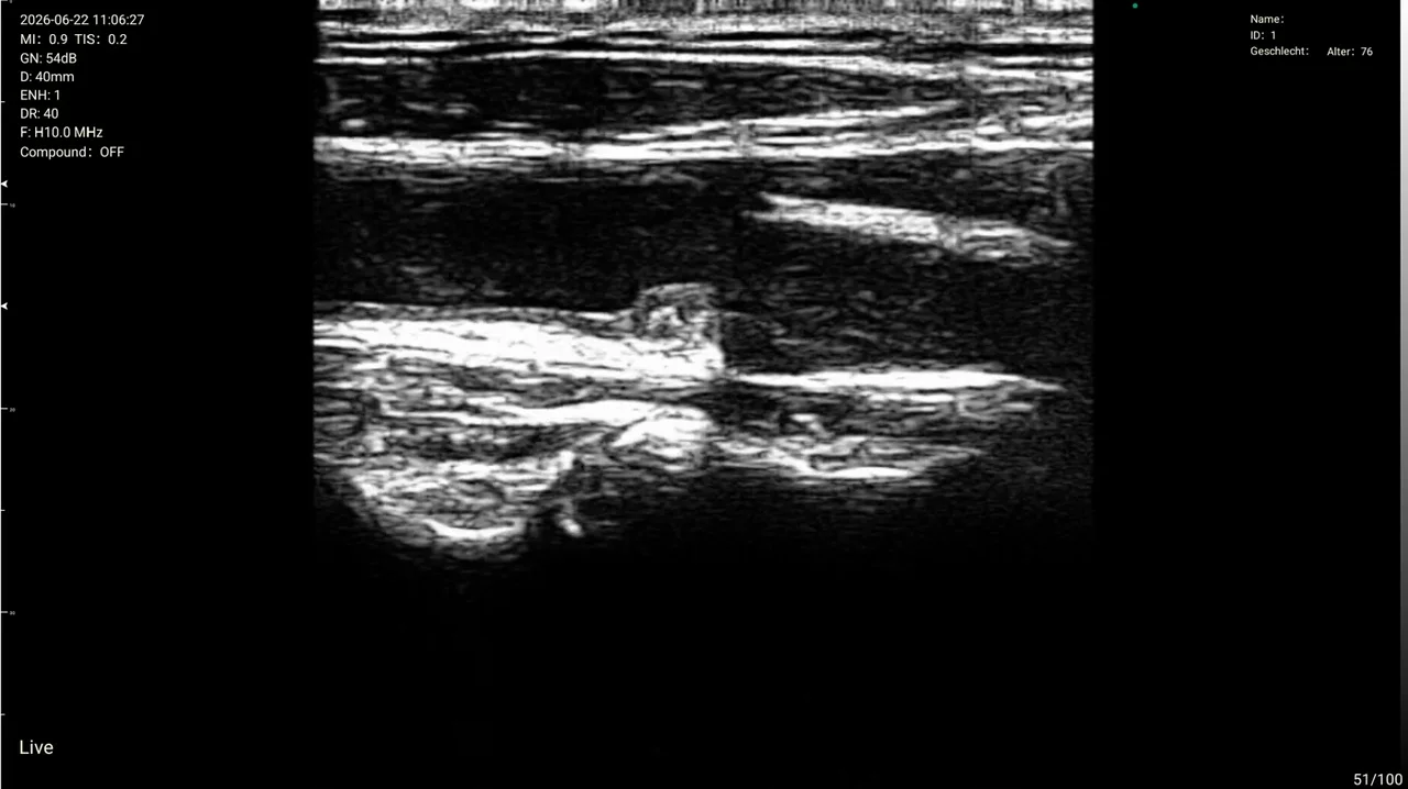Brachial plexus ultrasound long axis on Suresult D3Ultra