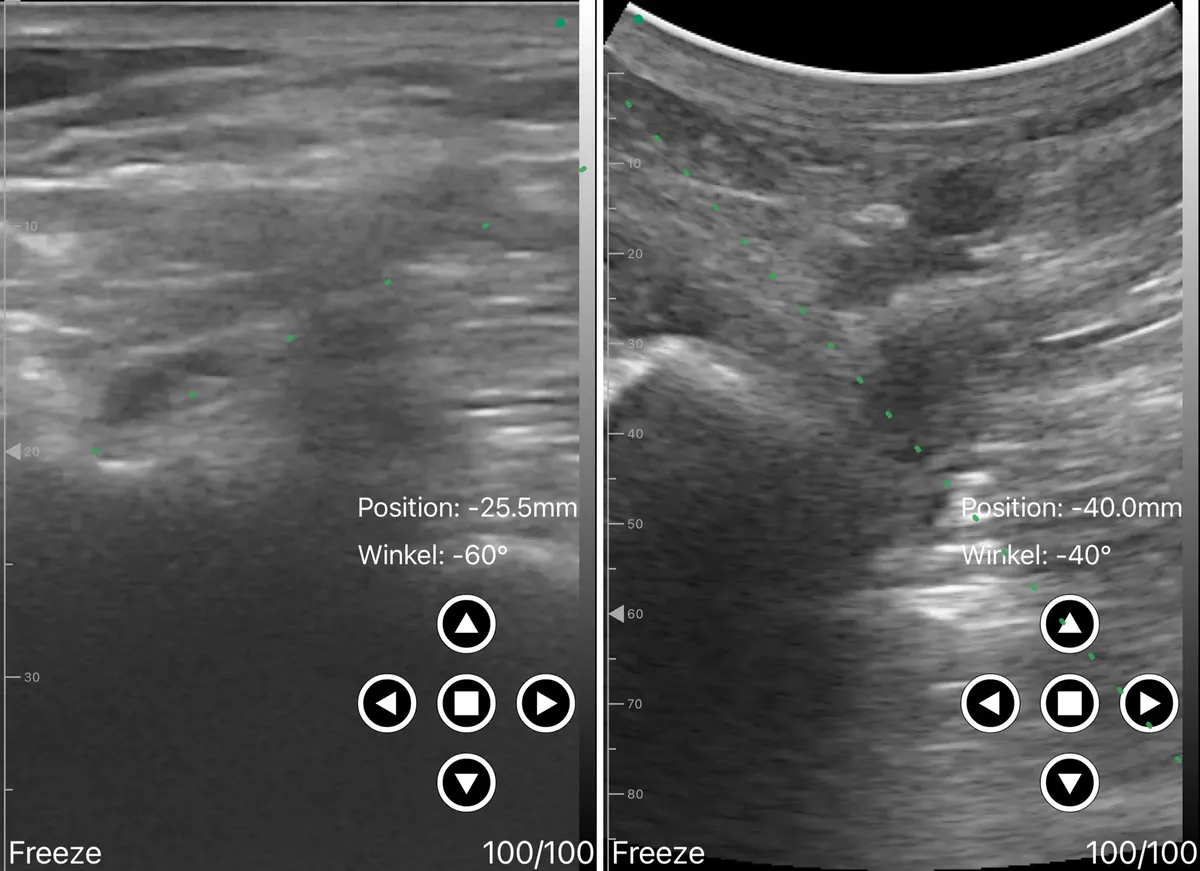 Interscalene on the linear head beside a deep sciatic window on the convex head, one D3Ultra