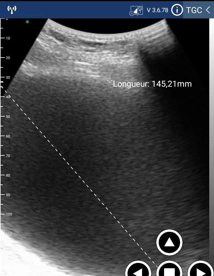 Large abdominal fluid collection &mdash; 145 mm long axis