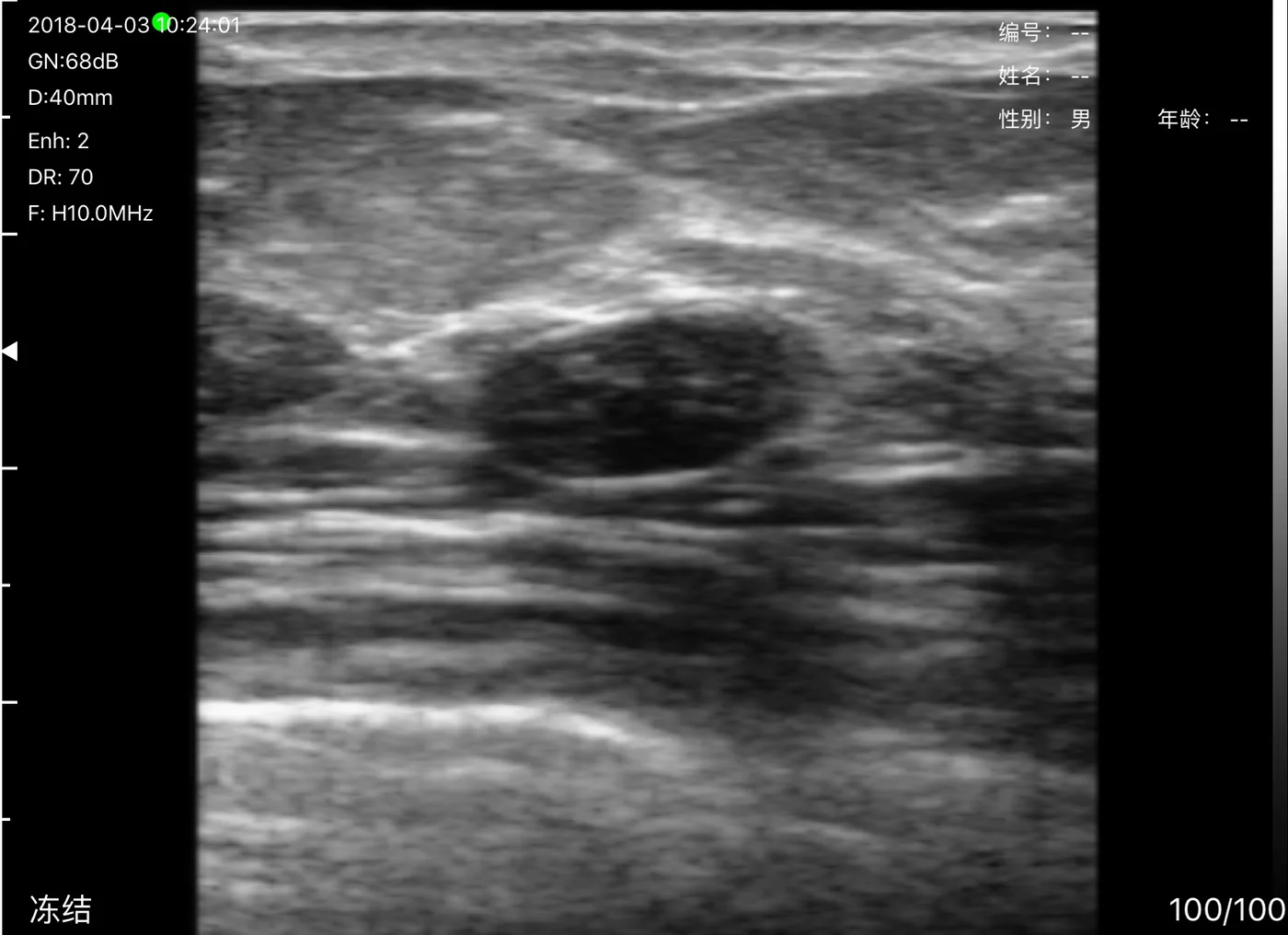 Breast-tissue B-mode reference