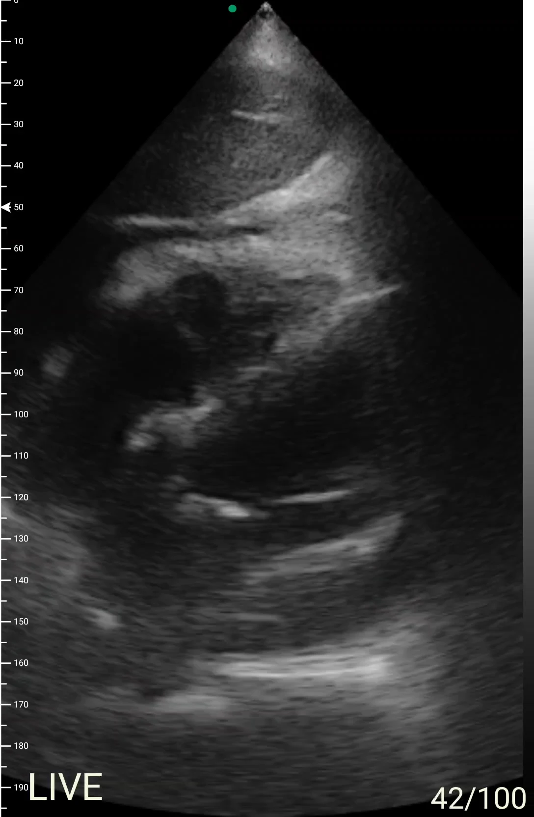 Live cardiac cine with pericardial effusion