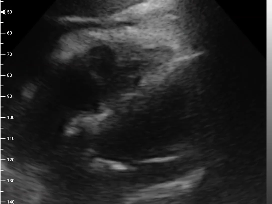 Cardiac ultrasound with pericardial effusion