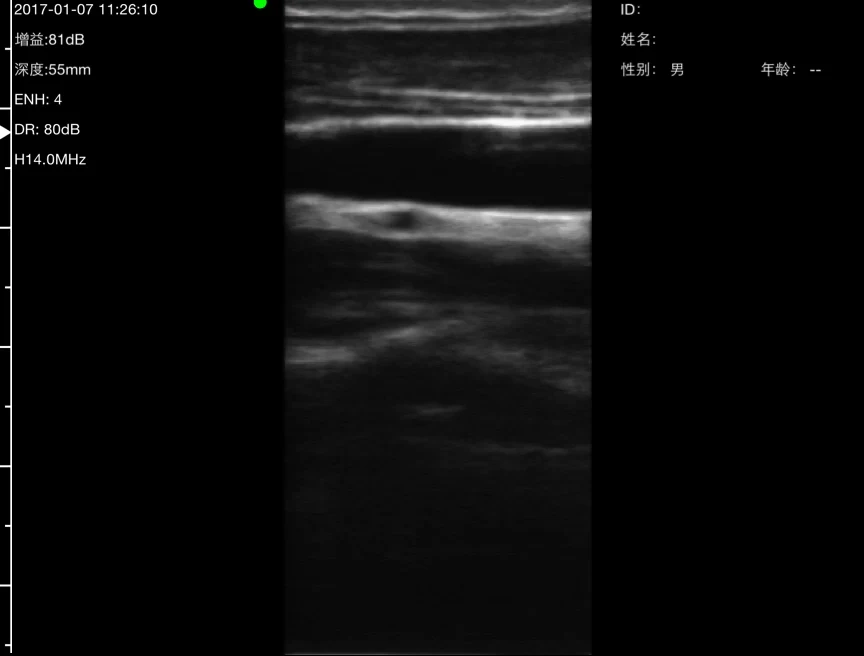 Live carotid long-axis cine