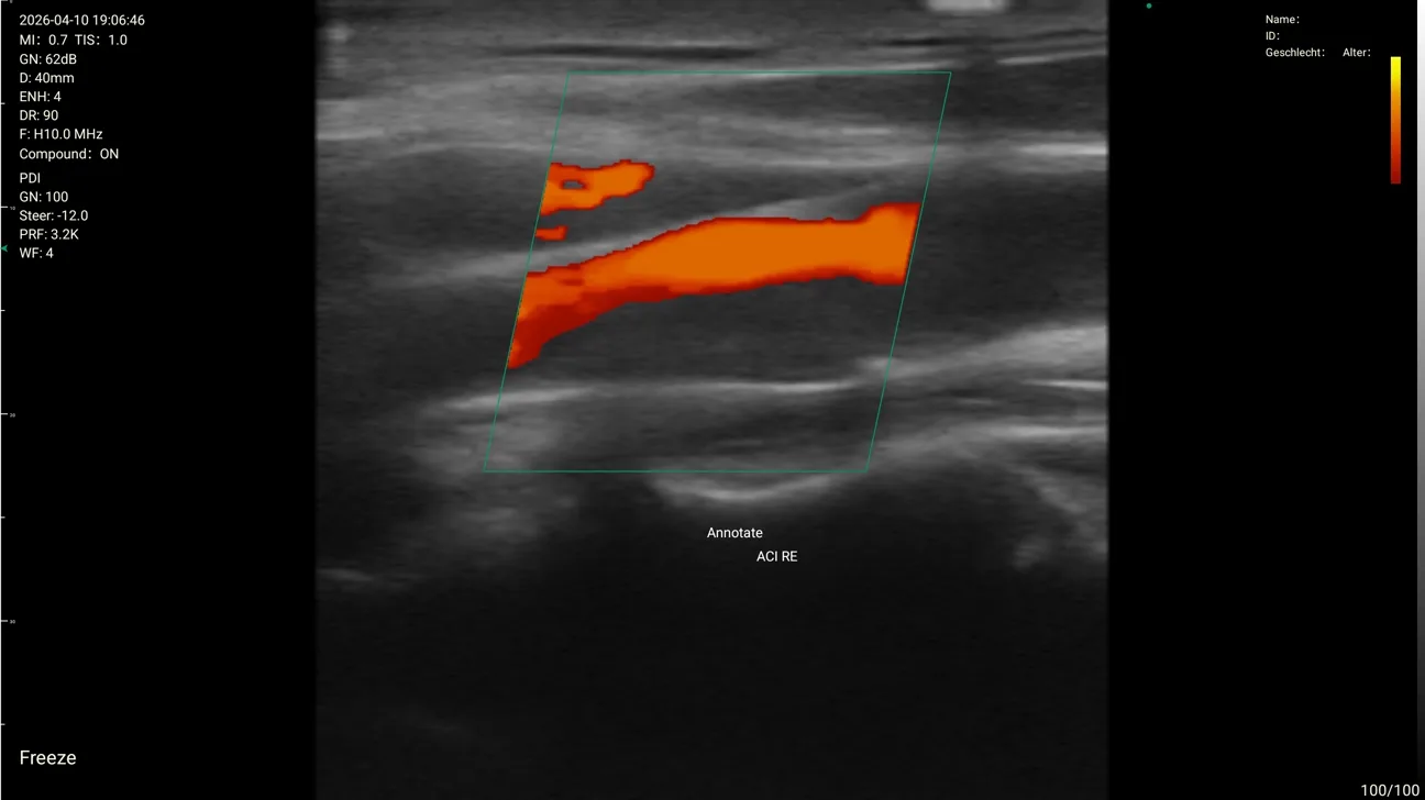 Right internal carotid PDI at 10 MHz