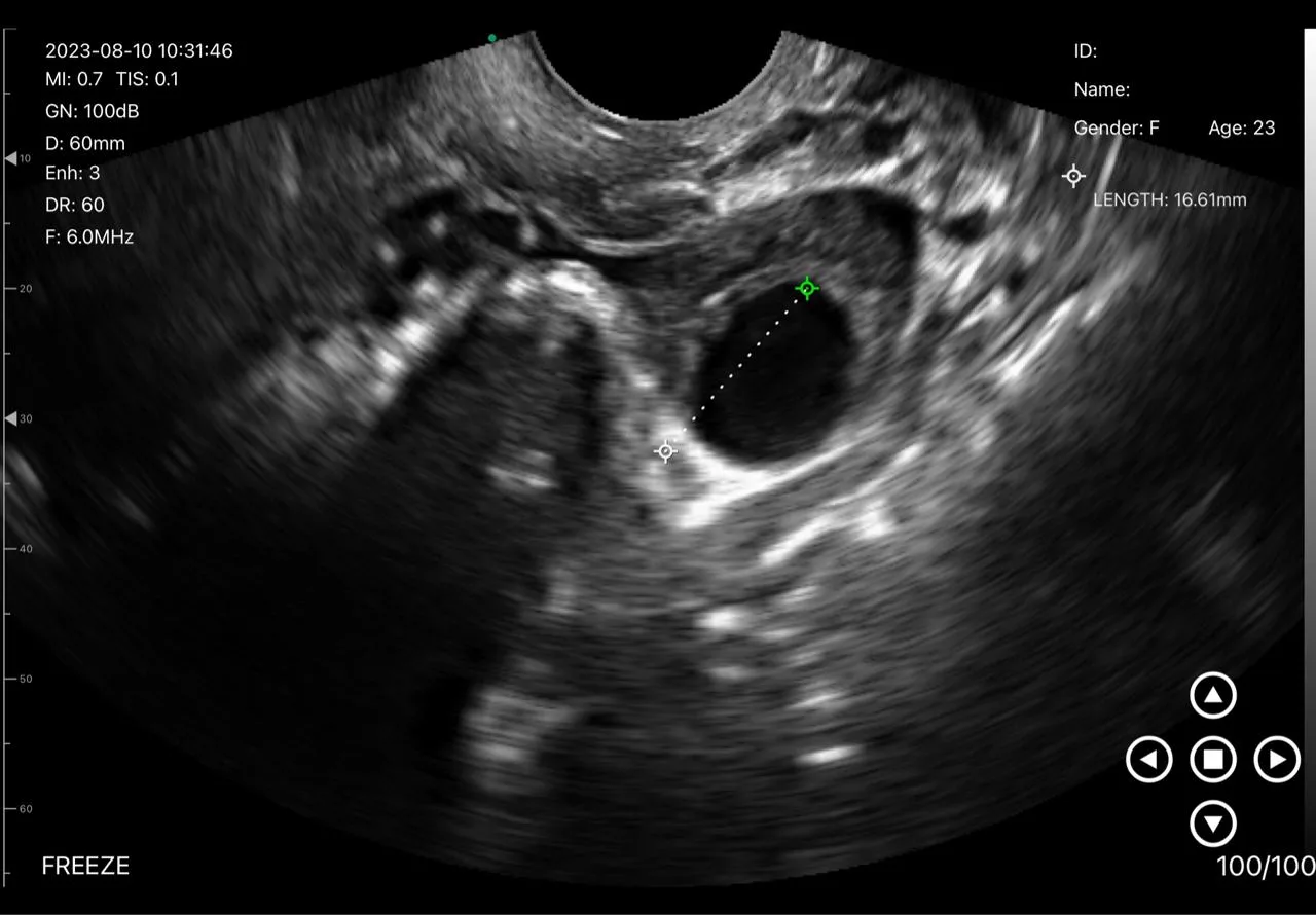 Ovarian cystic structure &mdash; 16.61 mm
