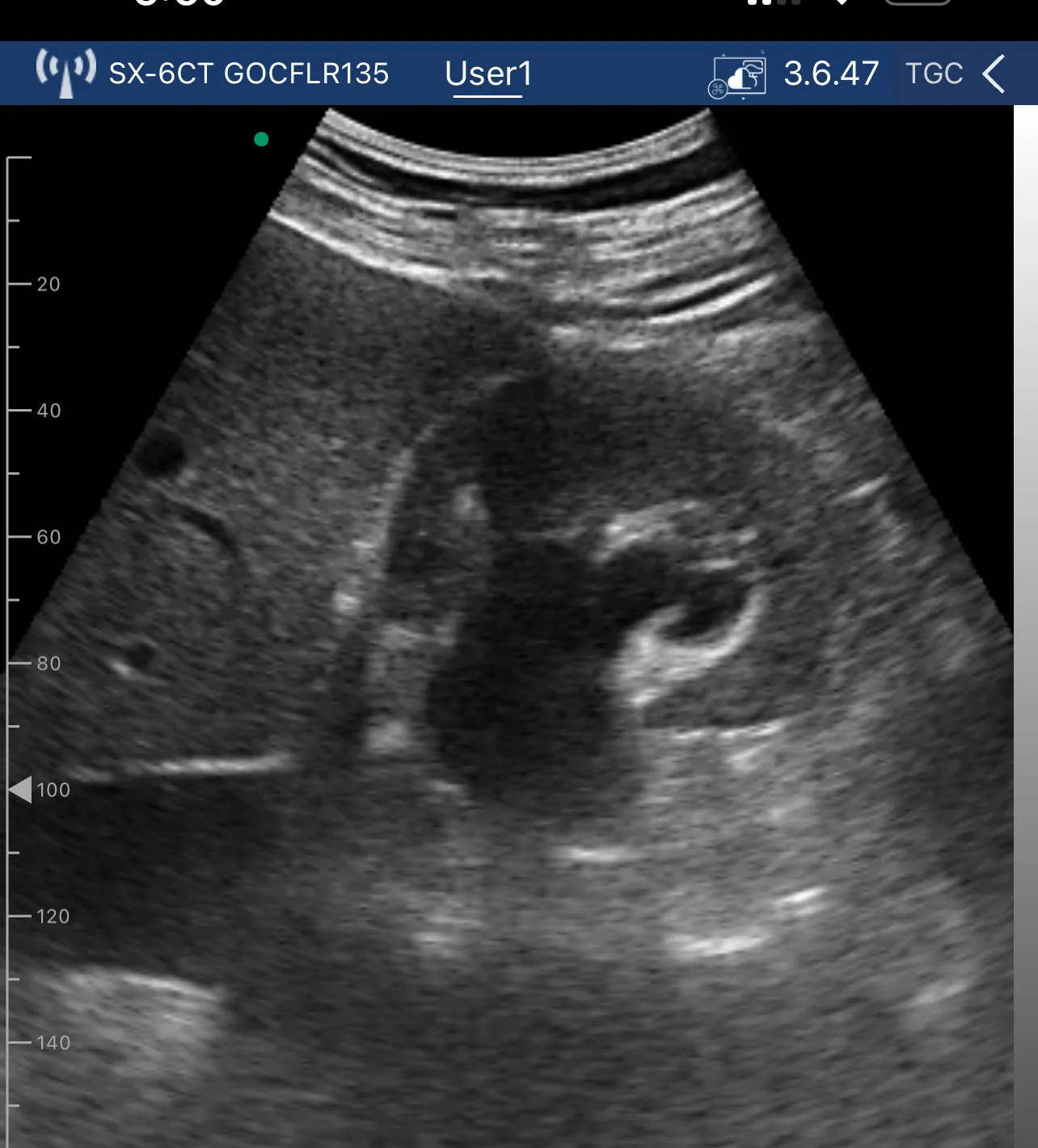 Moderate right hydronephrosis