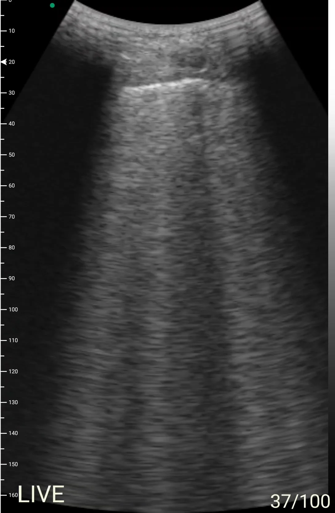 Diffuse B-lines &mdash; acute pulmonary edema