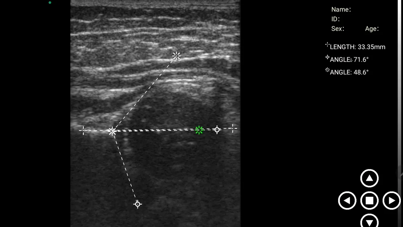 Infant hip &mdash; Graf angle measurement